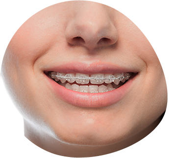 https://morthodontics.care/wp-content/uploads/2023/08/Clear-braces.png